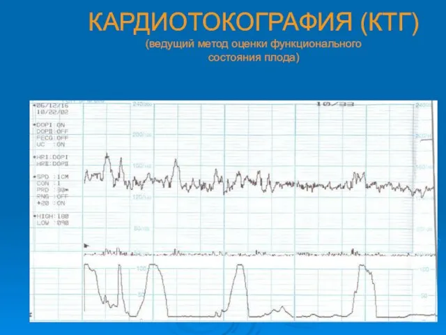 КАРДИОТОКОГРАФИЯ (КТГ) (ведущий метод оценки функционального состояния плода)