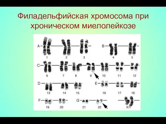 Филадельфийская хромосома при хроническом миелолейкозе