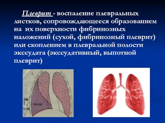 Плеврит - воспаление плевральных листков, сопровождающееся образованием на их поверхности фибринозных