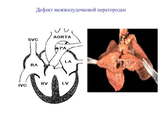 Дефект межжелудочковой перегородки