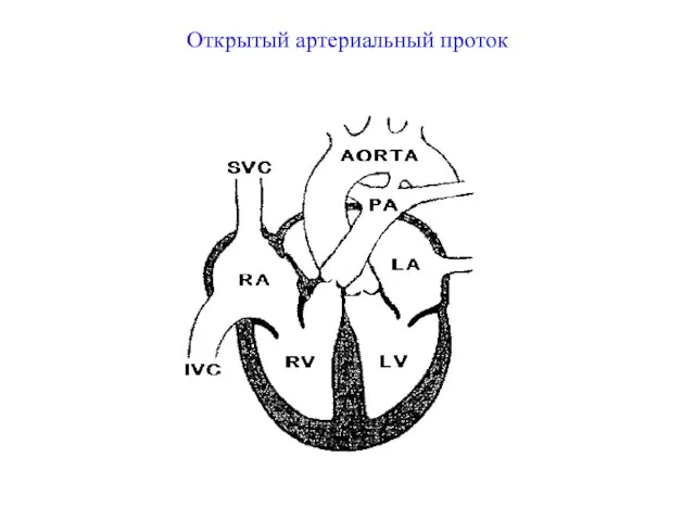 Открытый артериальный проток