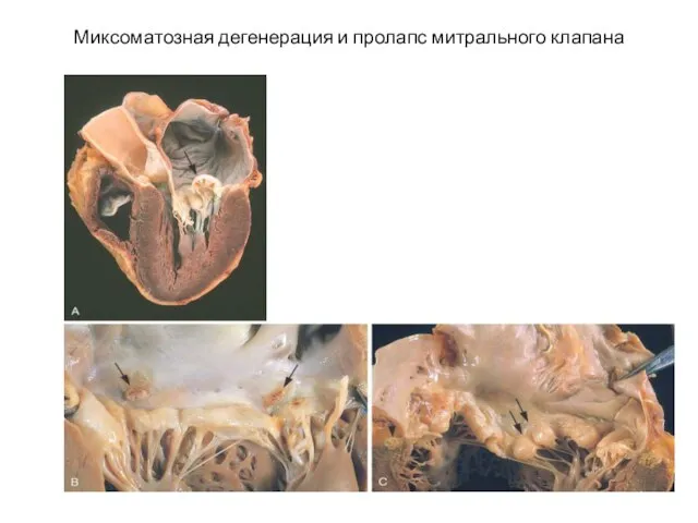 Миксоматозная дегенерация и пролапс митрального клапана