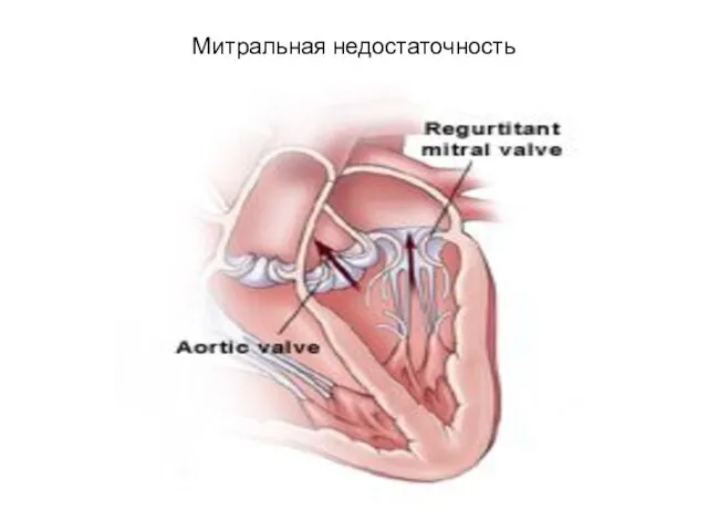 Митральная недостаточность