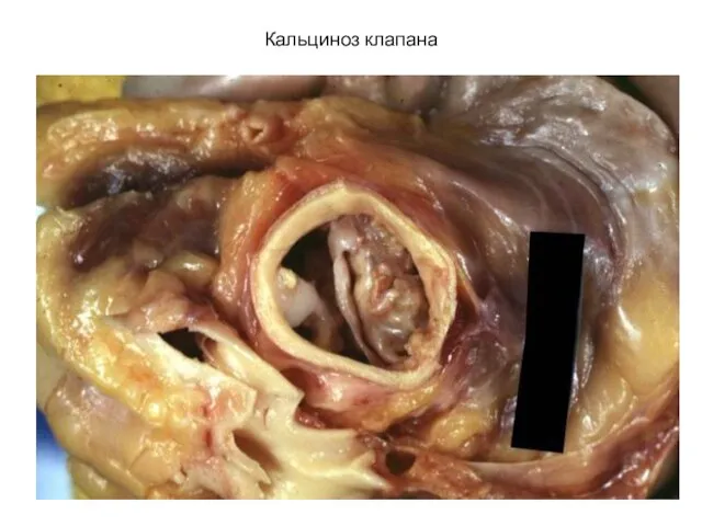 Кальциноз клапана