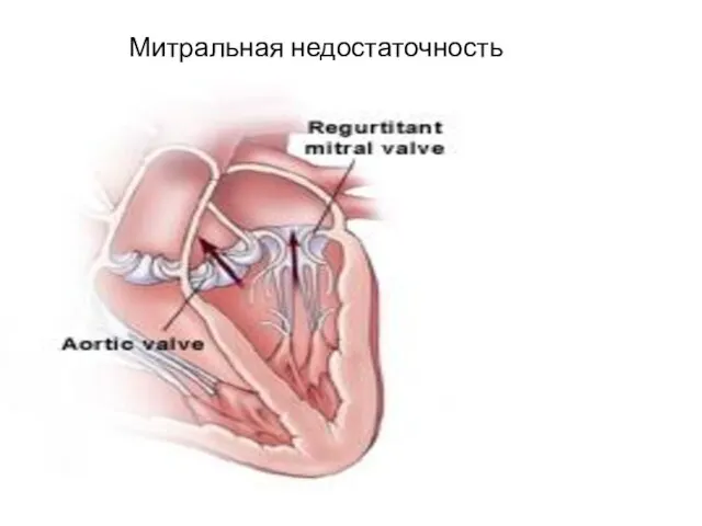 Митральная недостаточность