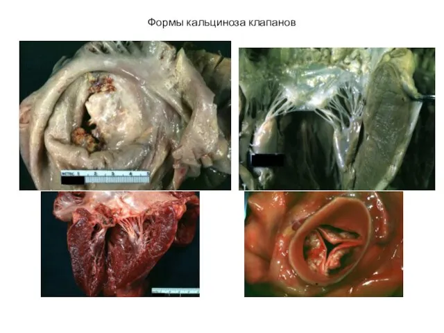 Формы кальциноза клапанов