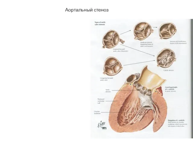Аортальный стеноз