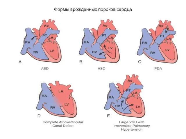 Формы врожденных пороков сердца