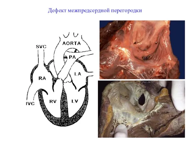 Дефект межпредсердной перегородки