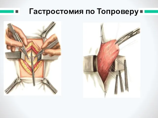 Гастростомия по Топроверу