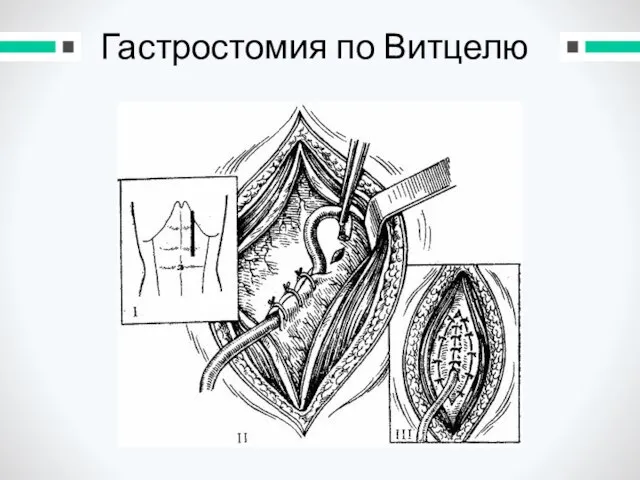 Гастростомия по Витцелю