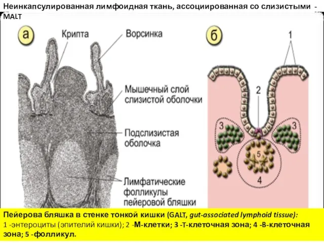 Неинкапсулированная лимфоидная ткань, ассоциированная со слизистыми - MALT Пейерова бляшка в