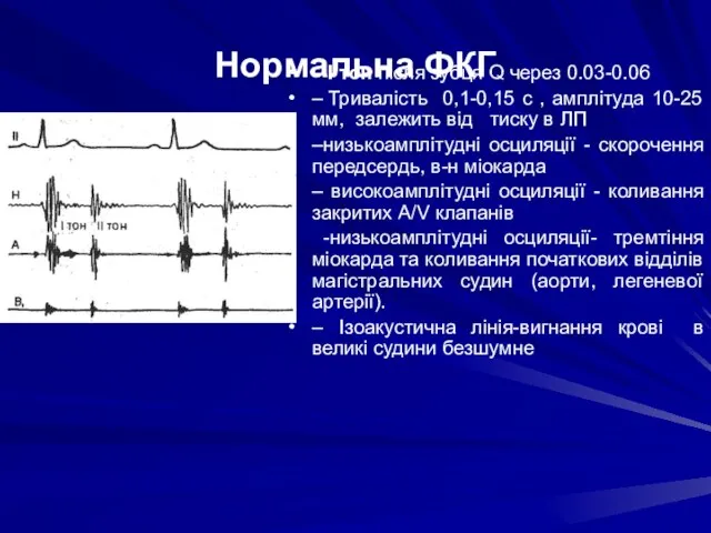 Нормальна ФКГ – І тон після зубця Q через 0.03-0.06 –