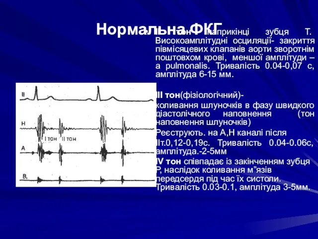 Нормальна ФКГ ІІ тон наприкінці зубця Т. Високоамплітудні осциляції- закриття півмісяцевих