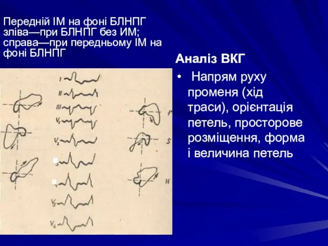 Передній ІМ на фоні БЛНПГ зліва—при БЛНПГ без ИМ; справа—при передньому