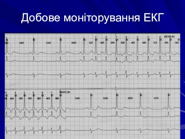 Добове моніторування ЕКГ