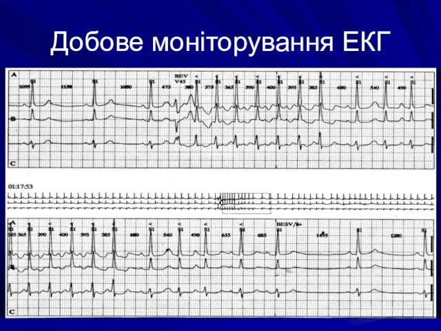 Добове моніторування ЕКГ