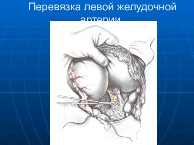 Перевязка левой желудочной артерии