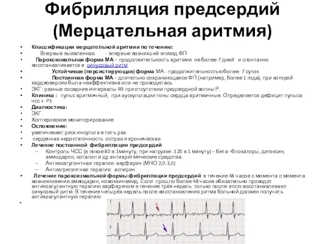 Фибрилляция предсердий (Мерцательная аритмия) Классификация мерцательной аритмии по течению: Впервые выявленная