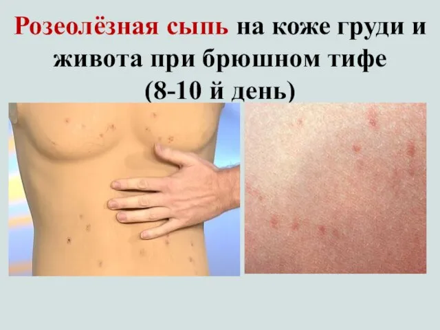 Розеолёзная сыпь на коже груди и живота при брюшном тифе (8-10 й день)