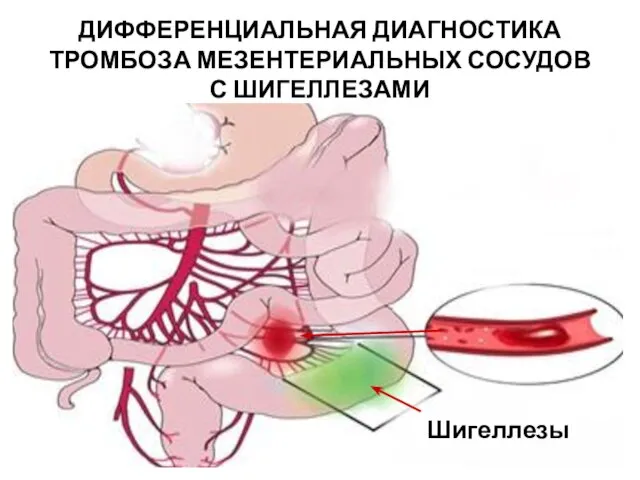 ДИФФЕРЕНЦИАЛЬНАЯ ДИАГНОСТИКА ТРОМБОЗА МЕЗЕНТЕРИАЛЬНЫХ СОСУДОВ С ШИГЕЛЛЕЗАМИ Шигеллезы