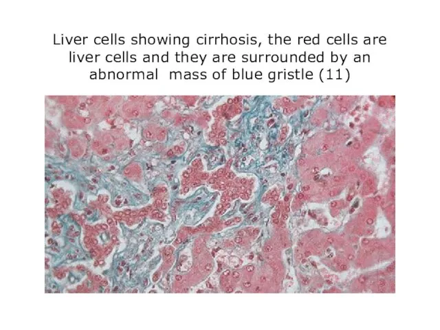 Liver cells showing cirrhosis, the red cells are liver cells and