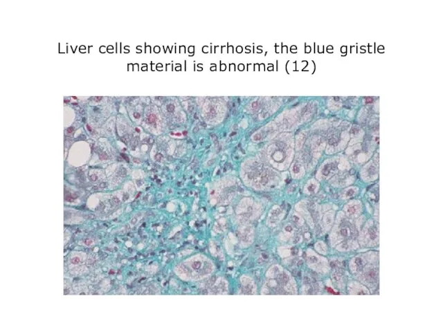 Liver cells showing cirrhosis, the blue gristle material is abnormal (12)