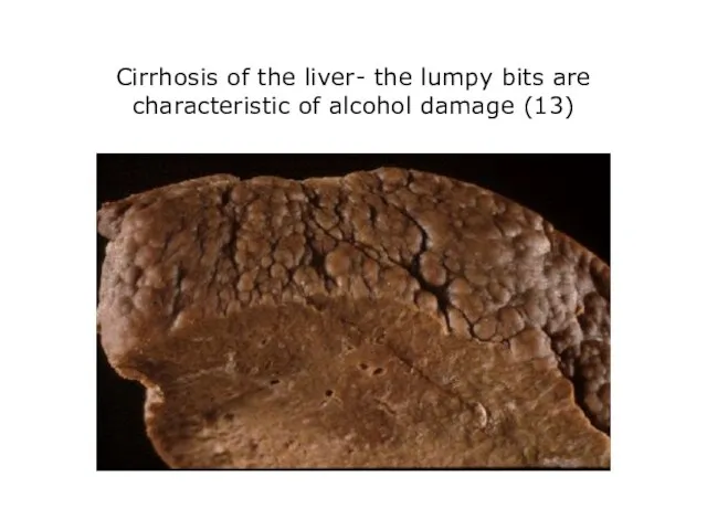 Cirrhosis of the liver- the lumpy bits are characteristic of alcohol damage (13)