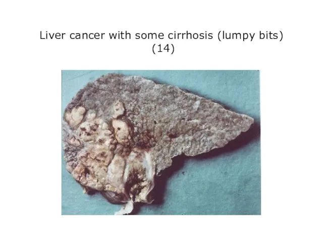 Liver cancer with some cirrhosis (lumpy bits) (14)