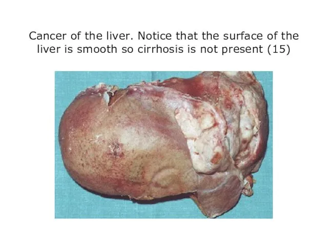 Cancer of the liver. Notice that the surface of the liver