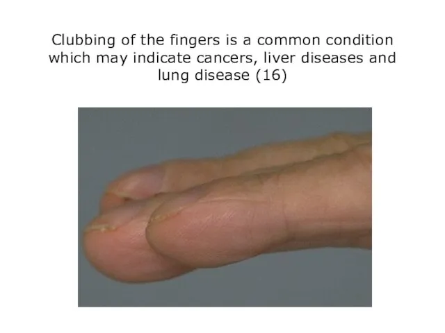 Clubbing of the fingers is a common condition which may indicate