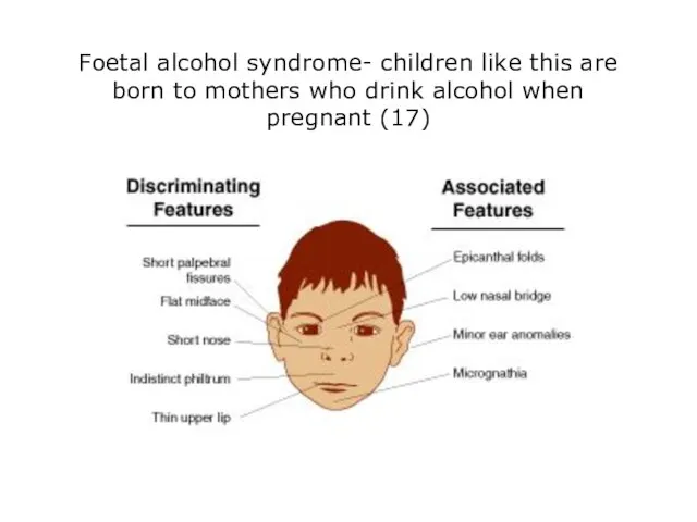 Foetal alcohol syndrome- children like this are born to mothers who drink alcohol when pregnant (17)