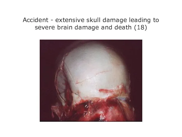 Accident - extensive skull damage leading to severe brain damage and death (18)