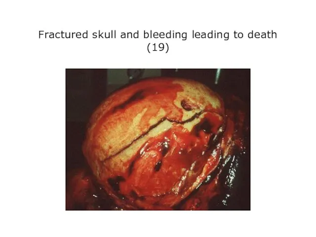 Fractured skull and bleeding leading to death (19)