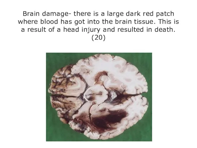 Brain damage- there is a large dark red patch where blood