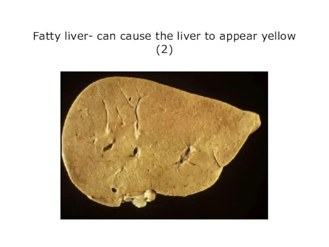 Fatty liver- can cause the liver to appear yellow (2)