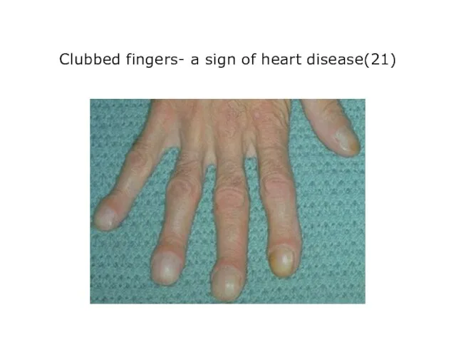 Clubbed fingers- a sign of heart disease(21)