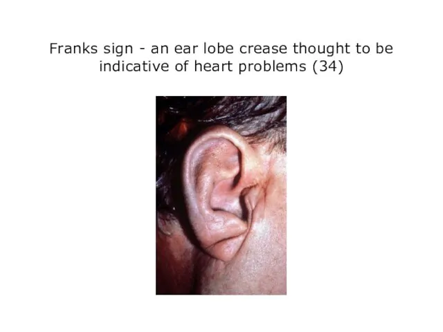 Franks sign - an ear lobe crease thought to be indicative of heart problems (34)