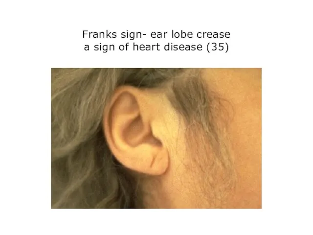 Franks sign- ear lobe crease a sign of heart disease (35)