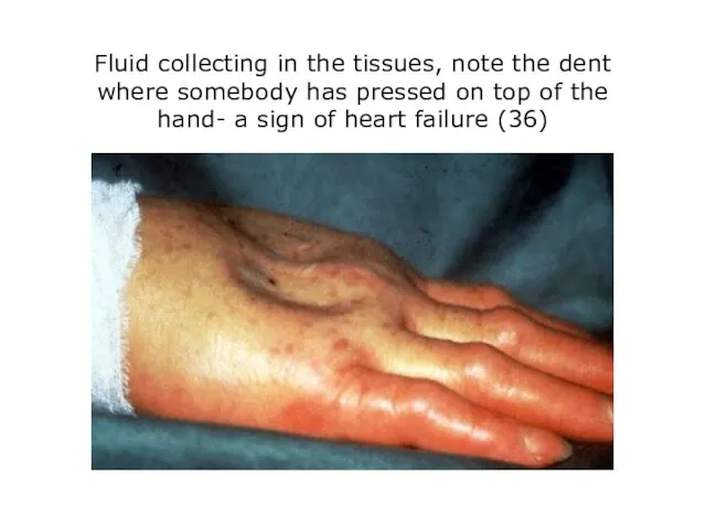 Fluid collecting in the tissues, note the dent where somebody has