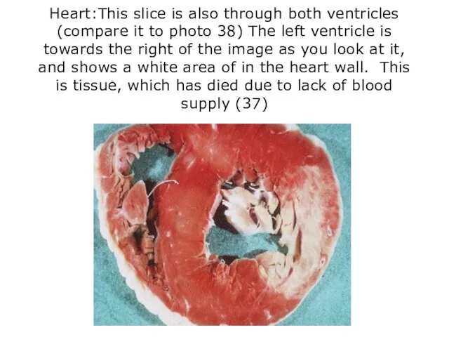 Heart:This slice is also through both ventricles (compare it to photo