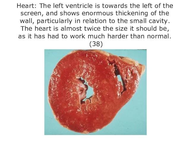 Heart: The left ventricle is towards the left of the screen,