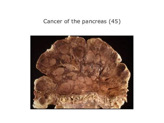 Cancer of the pancreas (45)