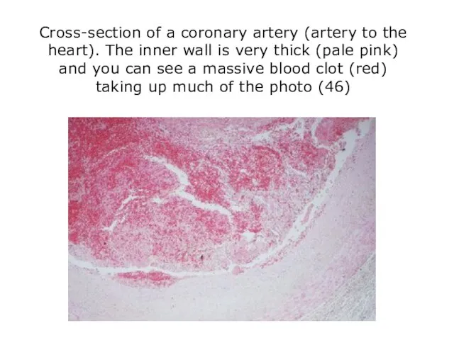 Cross-section of a coronary artery (artery to the heart). The inner