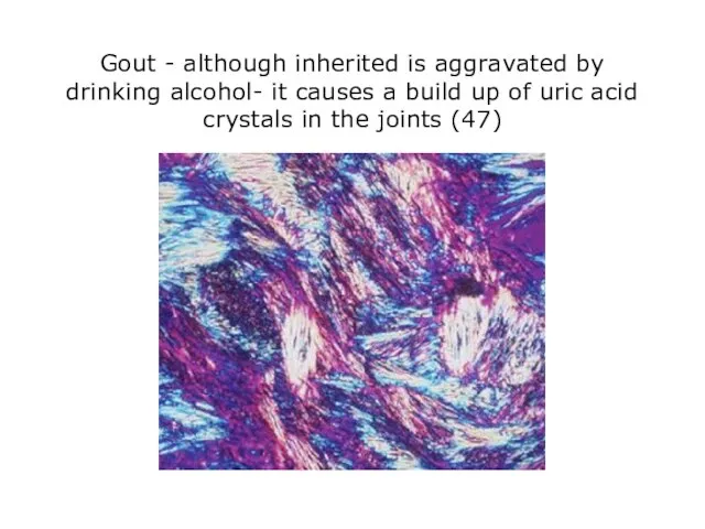 Gout - although inherited is aggravated by drinking alcohol- it causes