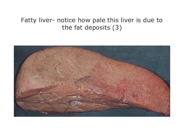 Fatty liver- notice how pale this liver is due to the fat deposits (3)