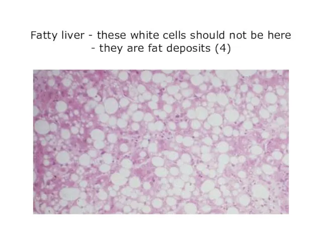 Fatty liver - these white cells should not be here - they are fat deposits (4)