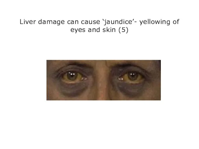 Liver damage can cause ‘jaundice’- yellowing of eyes and skin (5)