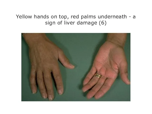 Yellow hands on top, red palms underneath - a sign of liver damage (6)