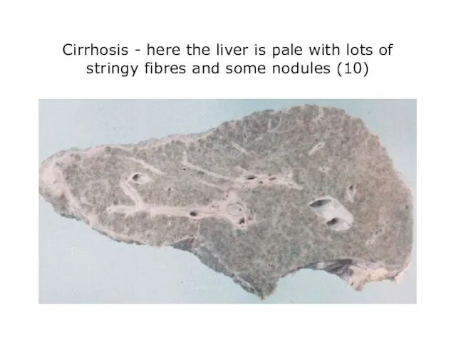 Cirrhosis - here the liver is pale with lots of stringy fibres and some nodules (10)